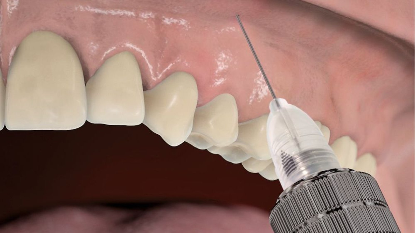 tandheelkundige anesthesie spuit