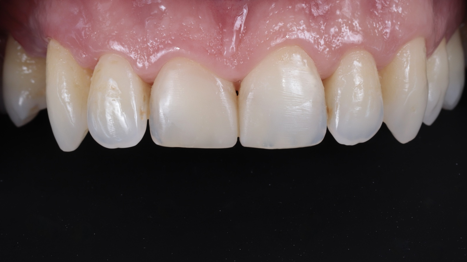 Een klinische casus met behulp van Venus Pearl Pure Shades door Dr. Riccardo Baratto 