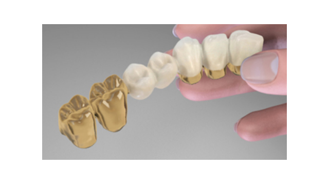 Crown- and Bridgework