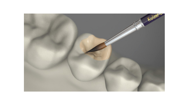 Metaalvrije Veneering