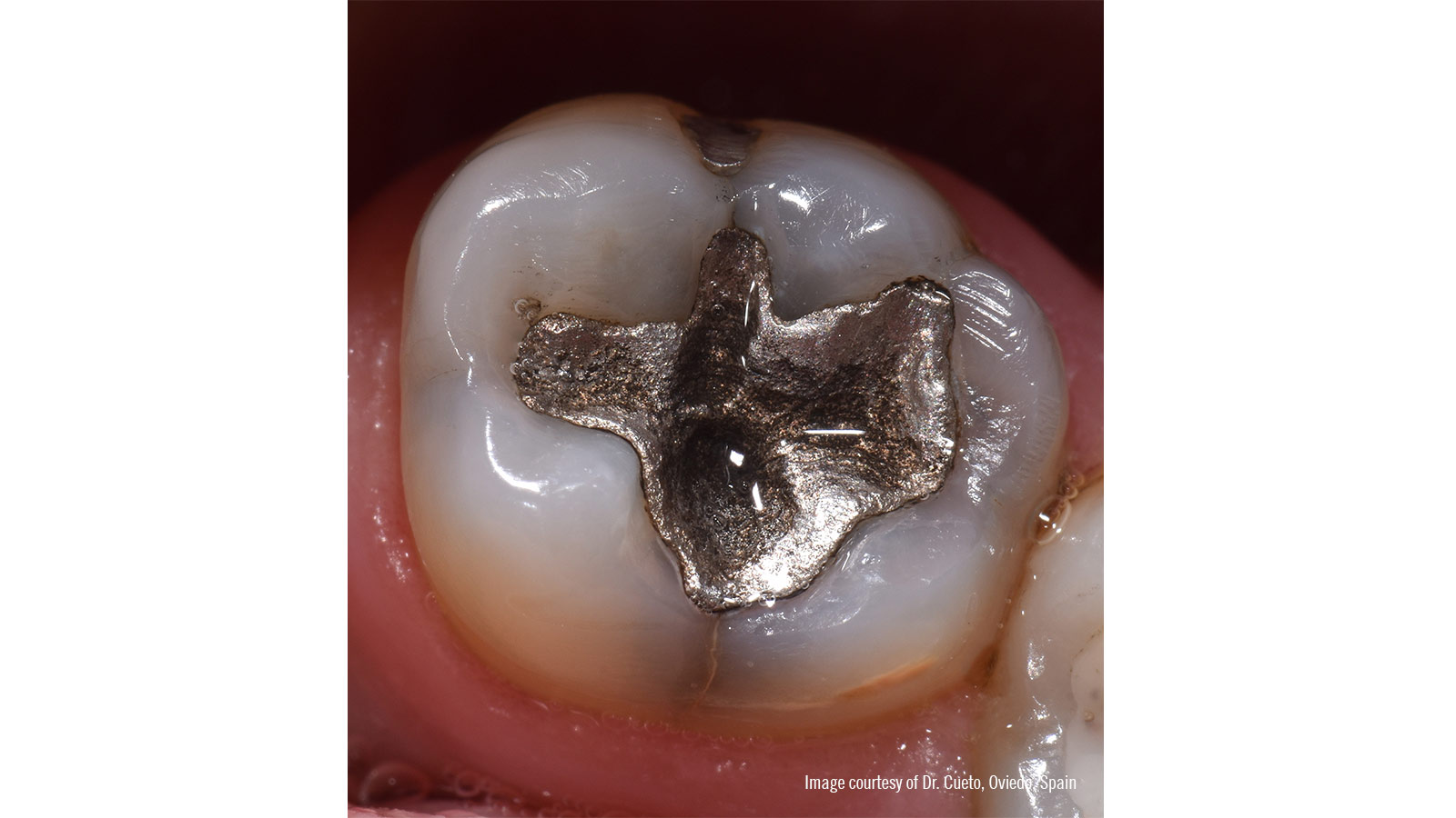 amalgam restoratio