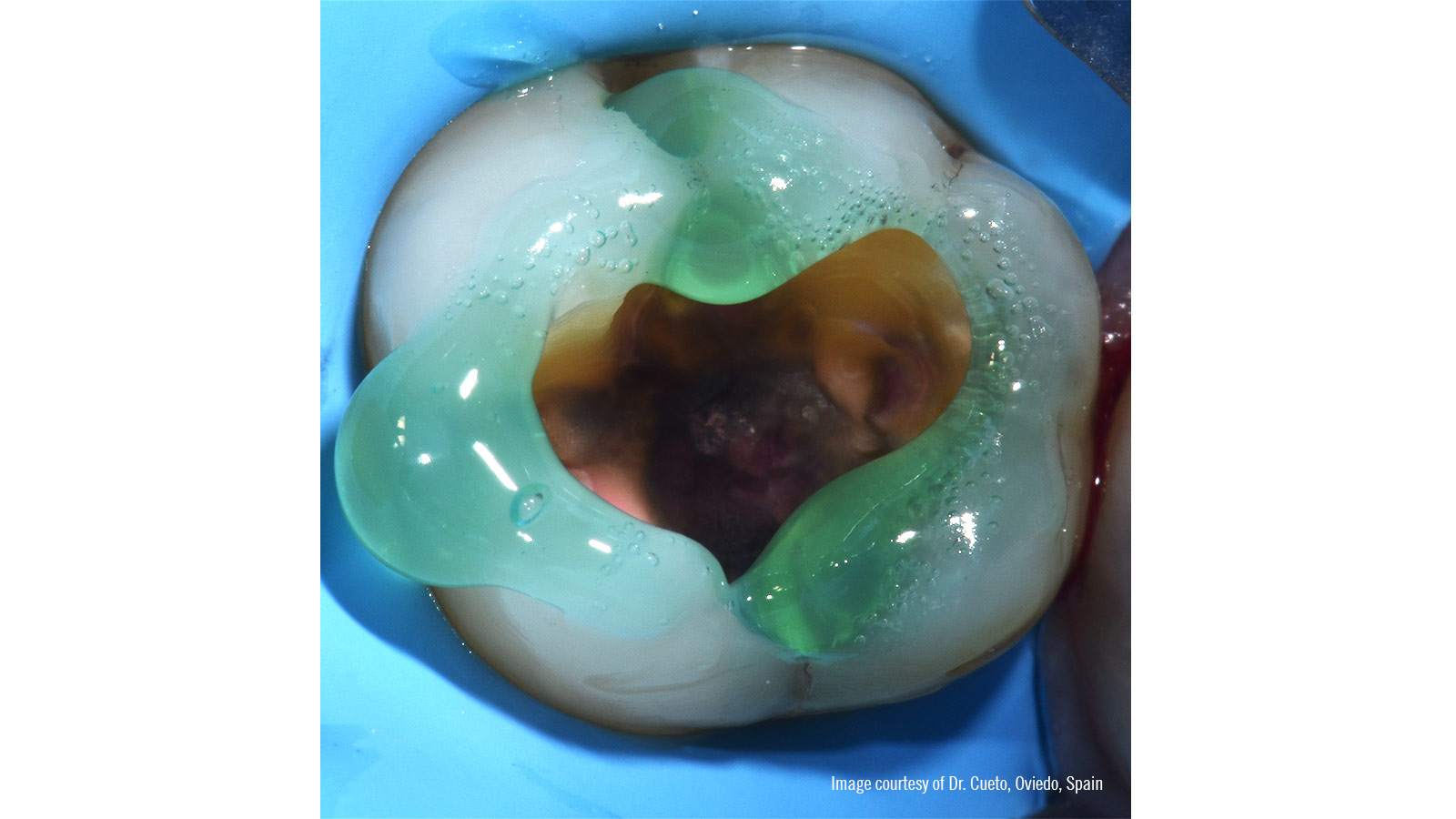 Selective enamel etching 