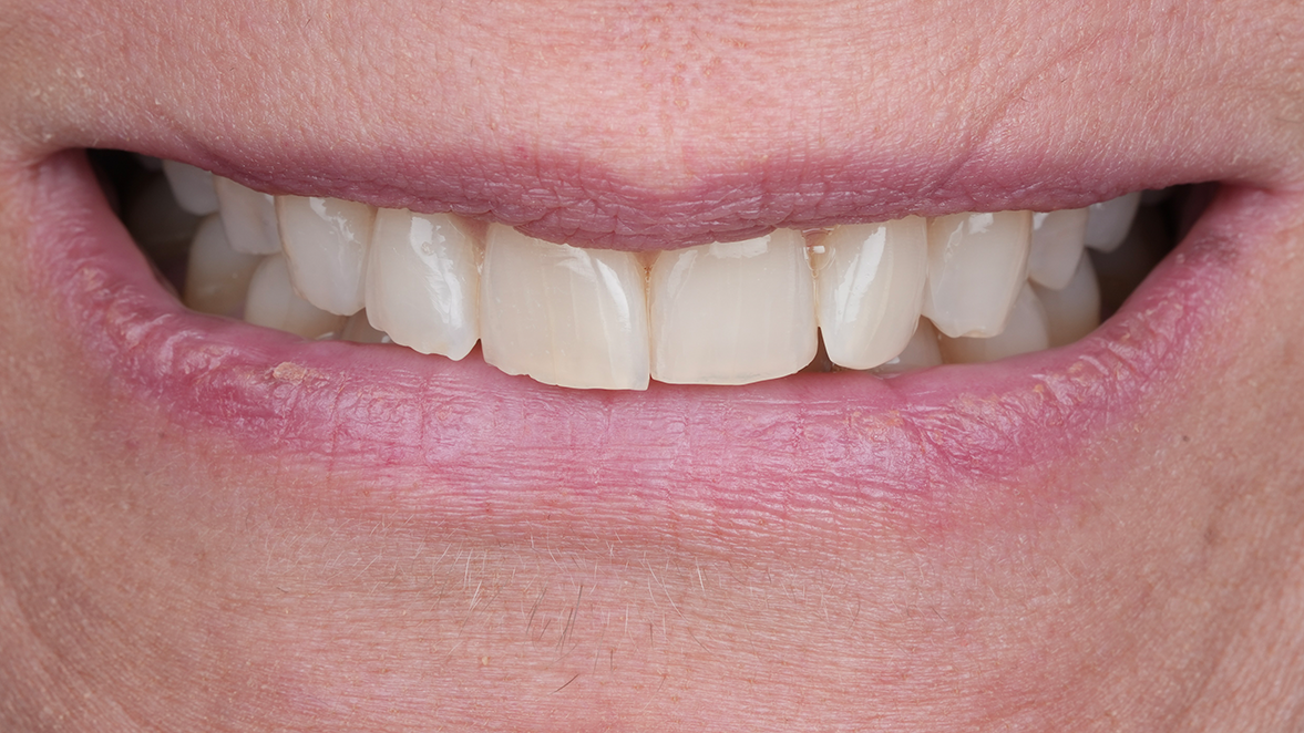 Kulzer Vivida_Casus door Dr. Edoardo Fossati, Italië_voorafgaand