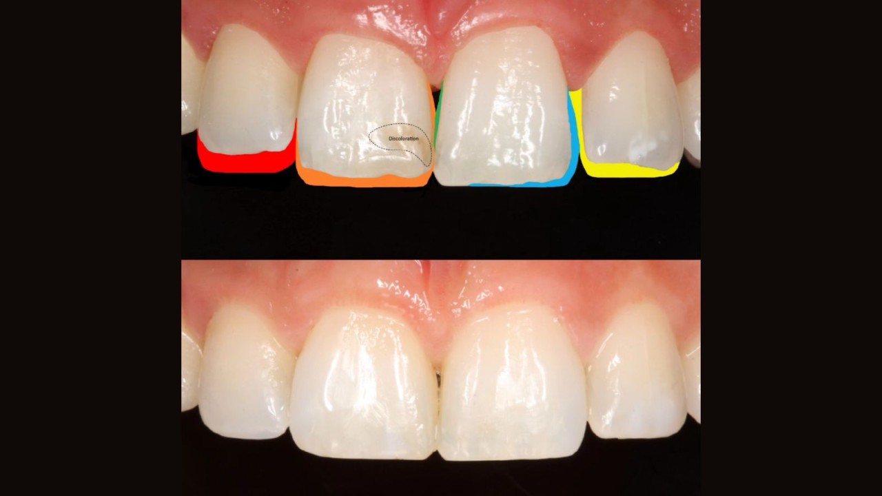 Eindresultaat van de monochromatische esthetische reconstructie van de voortanden.