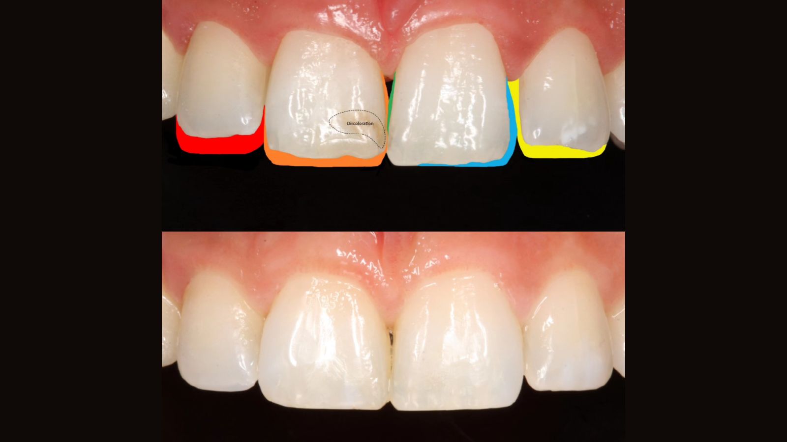 Eindresultaat van de monochromatische esthetische reconstructie van de voortanden.