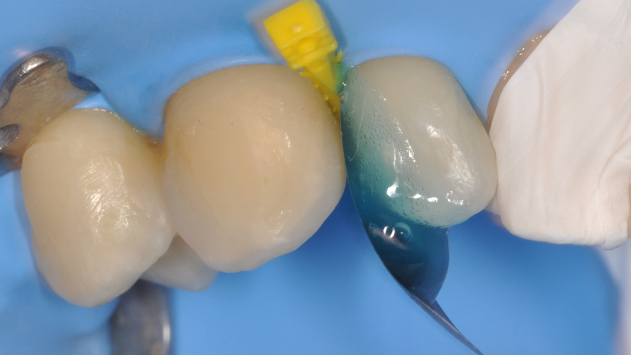 Etsen met iBOND Universal