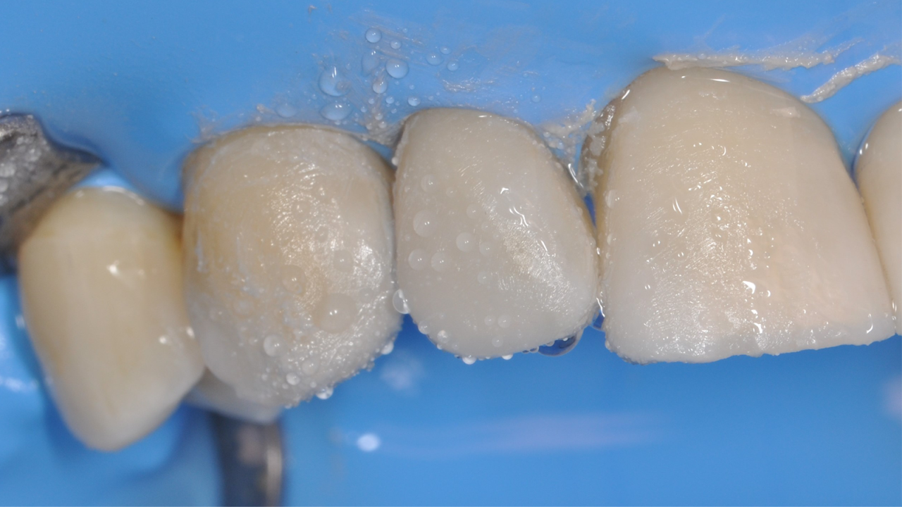 Polijsten met het Venus Supra two-step polishing systeem​.