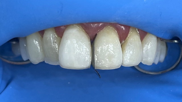  Tand-voor-tand reconstructie