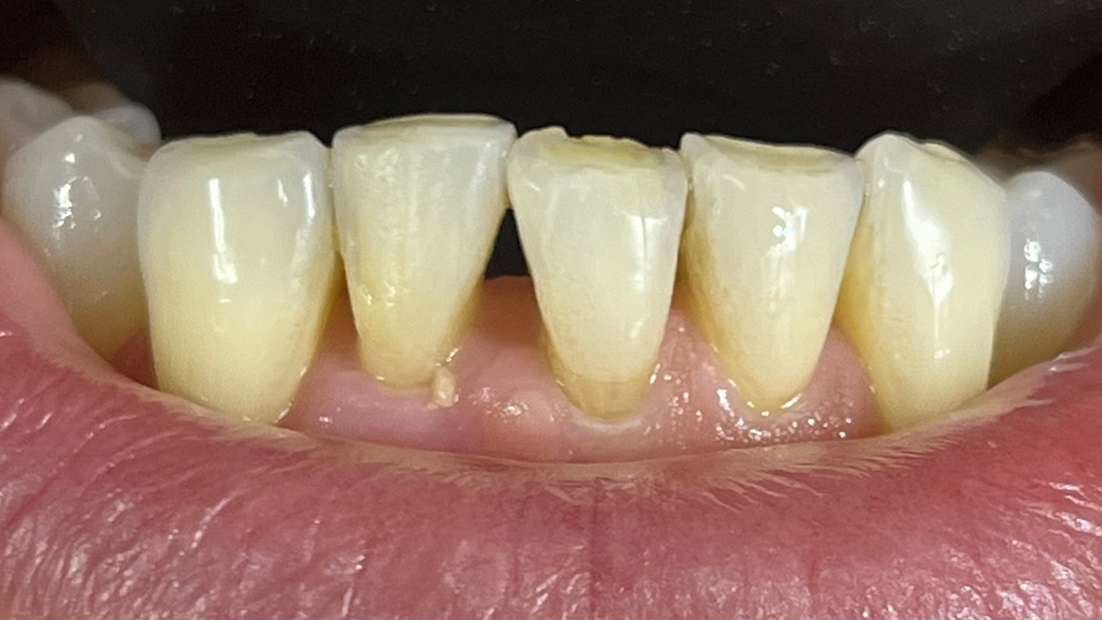 Onderfront na uitlijning.