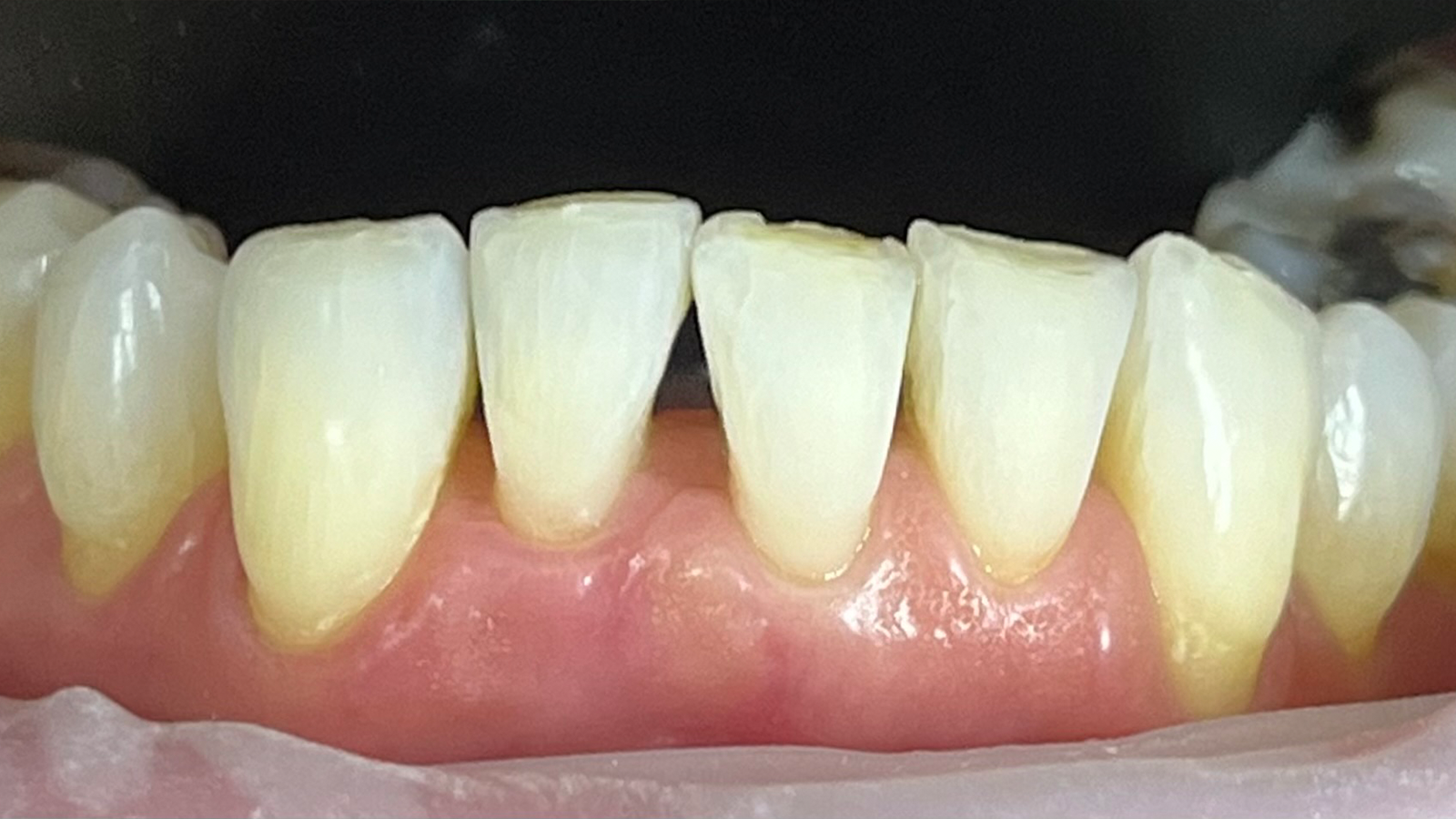 Situatie na uitlijning en bleken.