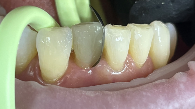 Tand-voor-tand reconstructie met composiet.