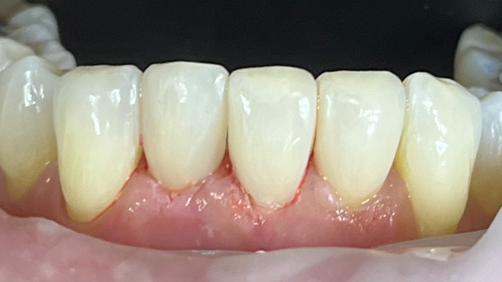 Eindresultaat van het onderfront.