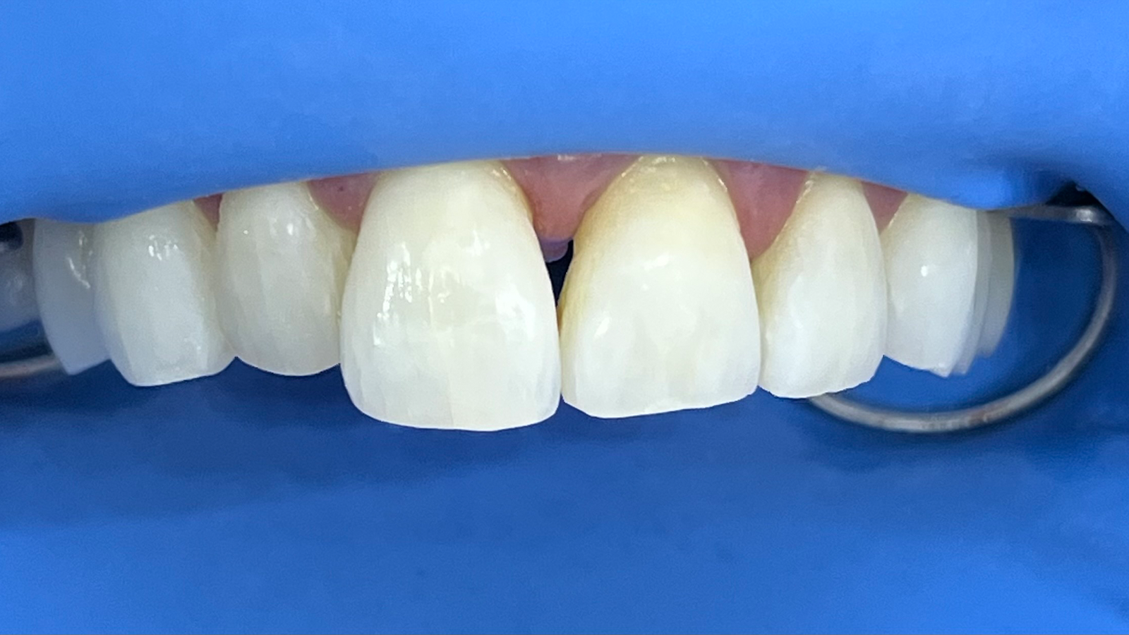 Rubberdamisolatie van het bovenfront.