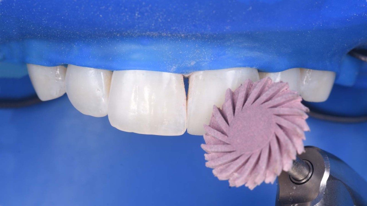 Polijsten van de buccale zijde met een andere vorm – de Venus Supra Twist Disc.