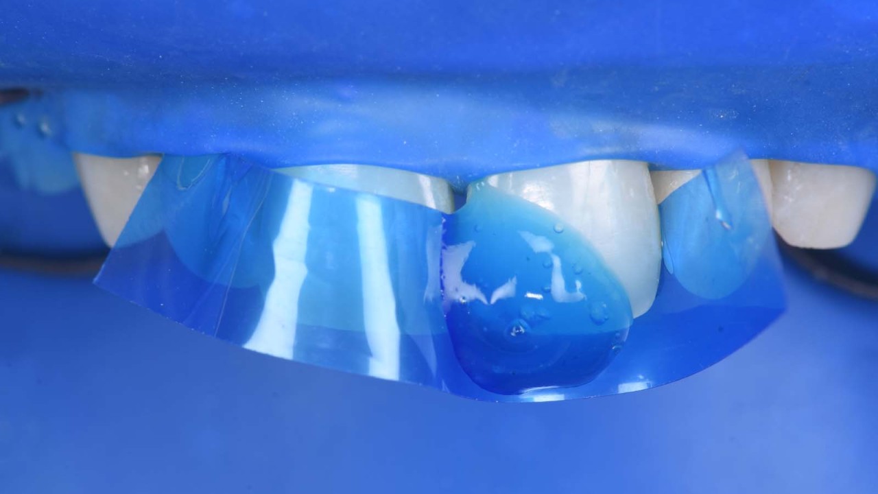  Voorbereiden van het tandoppervlak: etsen met iBOND Etch 35 Gel gedurende 20 seconden.