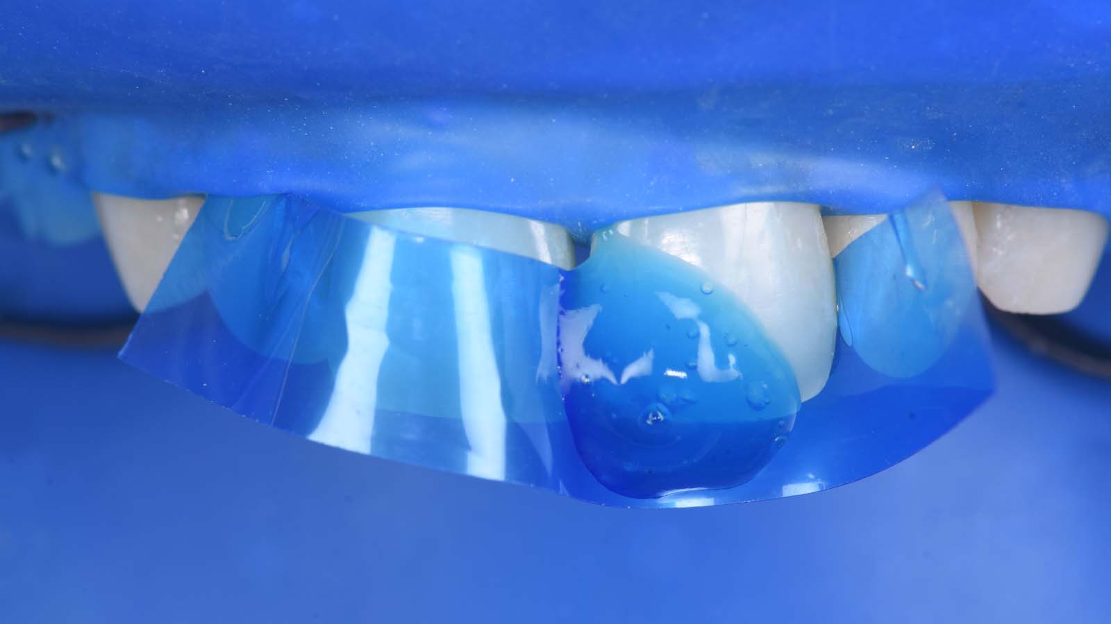  Voorbereiden van het tandoppervlak: etsen met iBOND Etch 35 Gel gedurende 20 seconden.