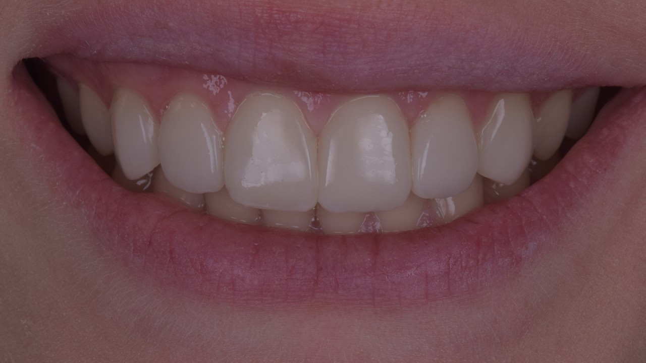 Resultaat na 4 jaar, na een snelle herpolijstbeurt.