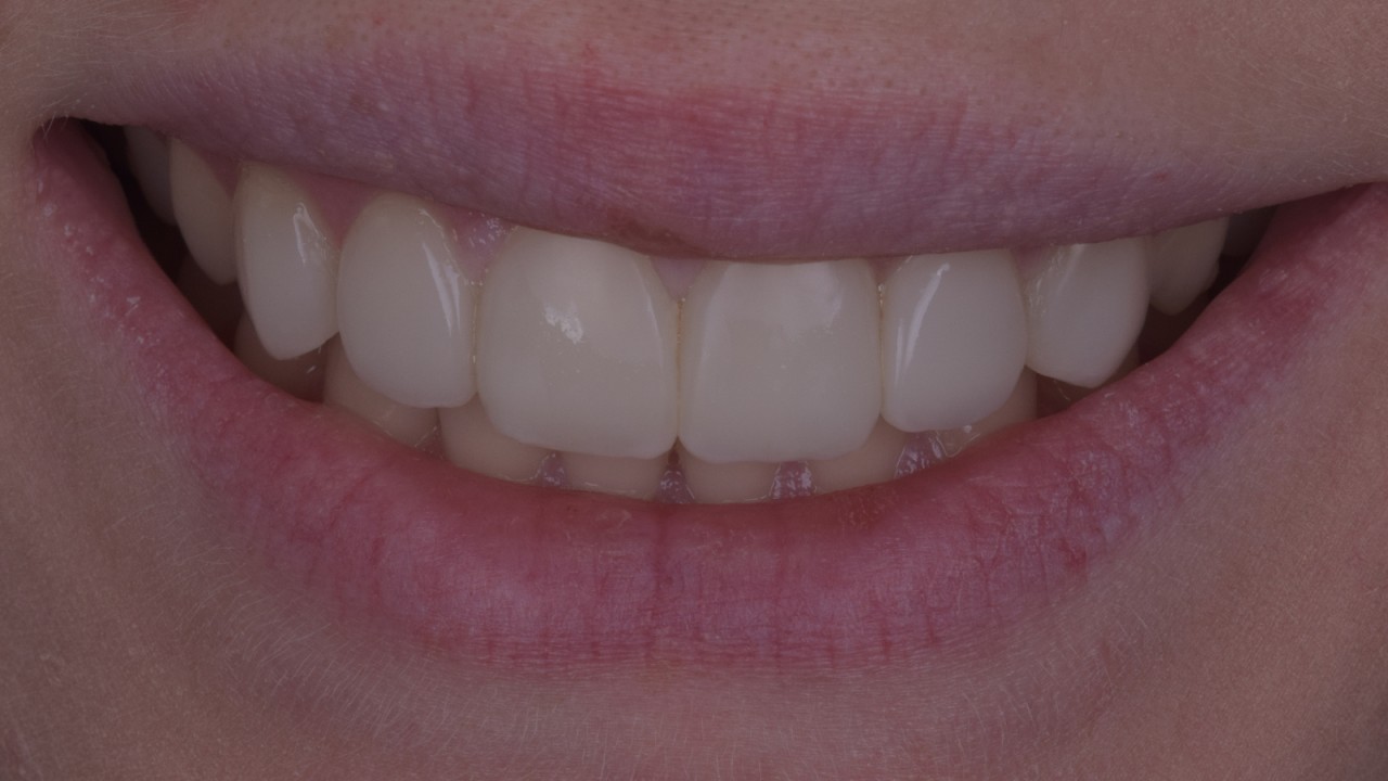 Resultaat na 4 jaar, vóór een snelle herpolijstbeurt.