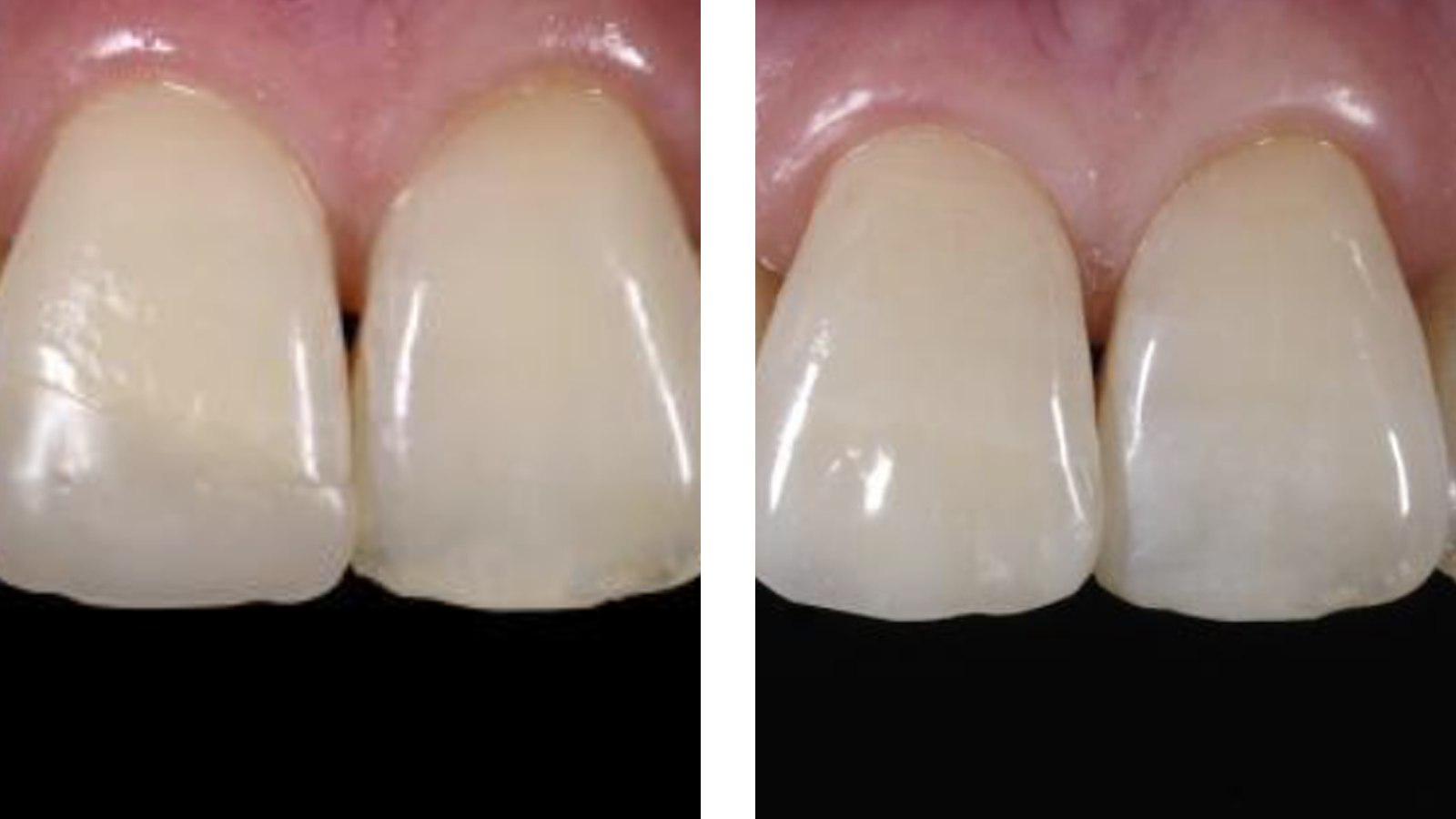 Restoration with Venus Pearl Art Shade by Ulf Krueger-Janson.